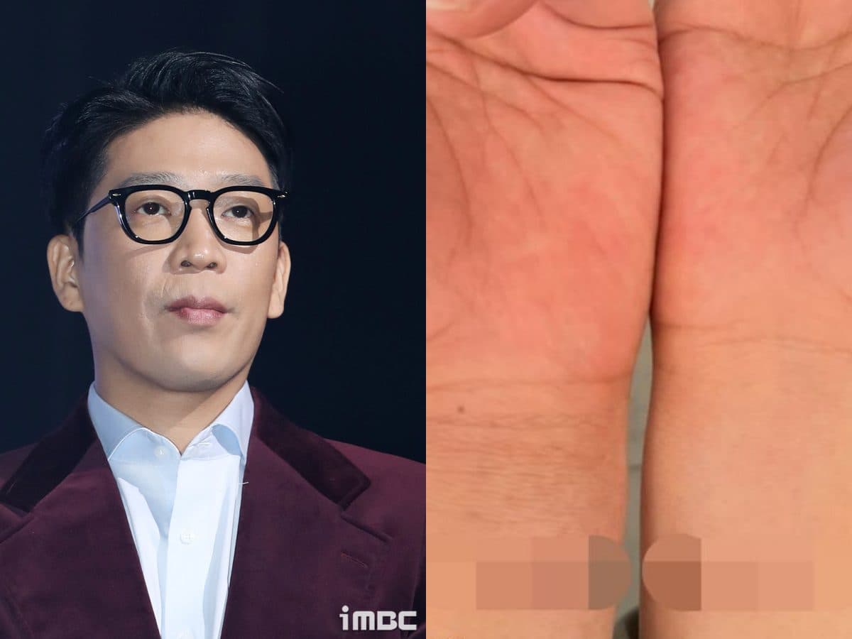 MC Mong Reveals Disturbing Photos of Wrist Injuries, Addresses Hitler Painting Controversy